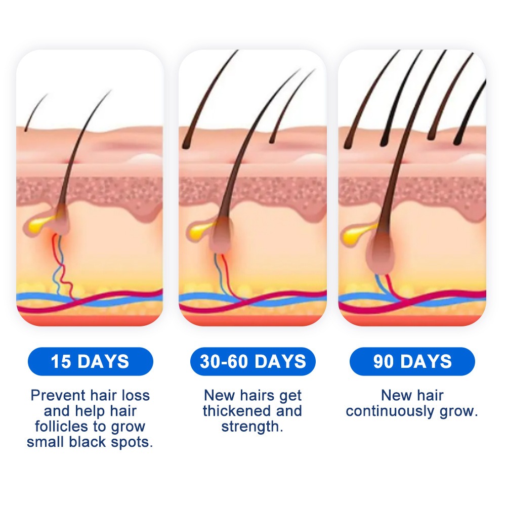 Alopecia Hair Growth Spray Sop - Hair Care Cream avis et prix
